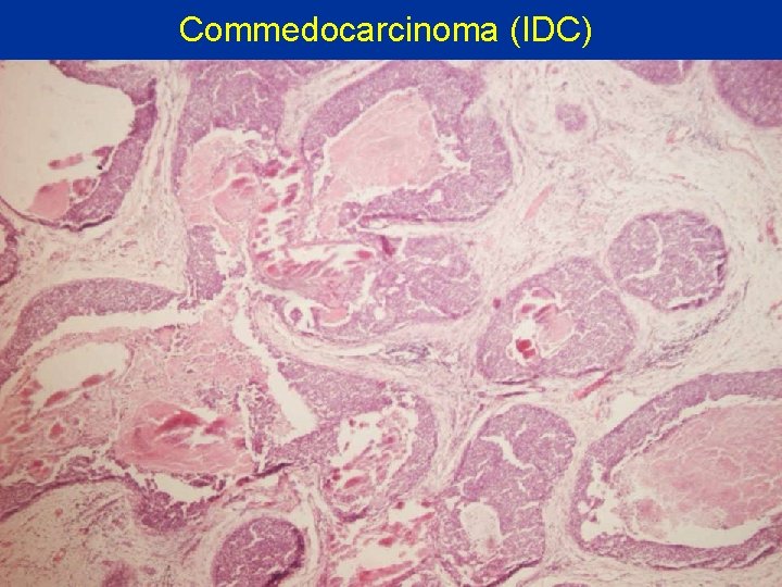 Commedocarcinoma (IDC) 