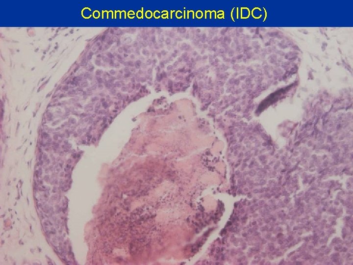 Commedocarcinoma (IDC) 