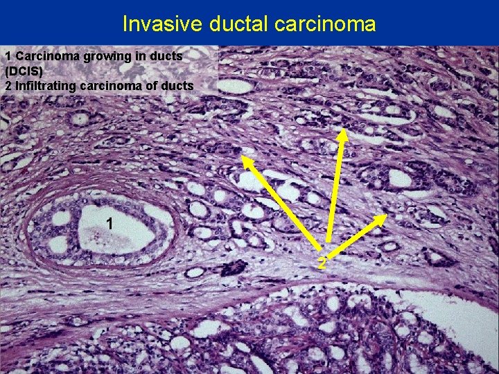 Invasive ductal carcinoma 1 Carcinoma growing in ducts (DCIS) 2 Infiltrating carcinoma of ducts