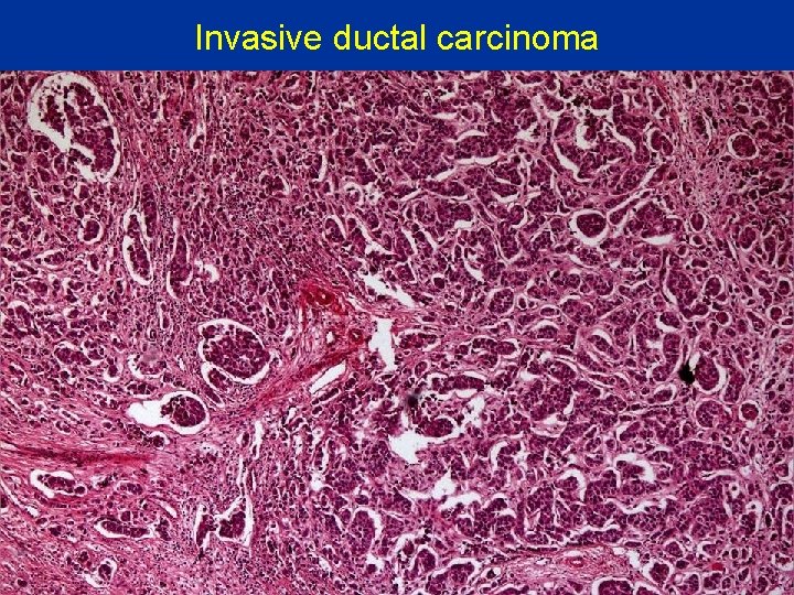 Invasive ductal carcinoma 