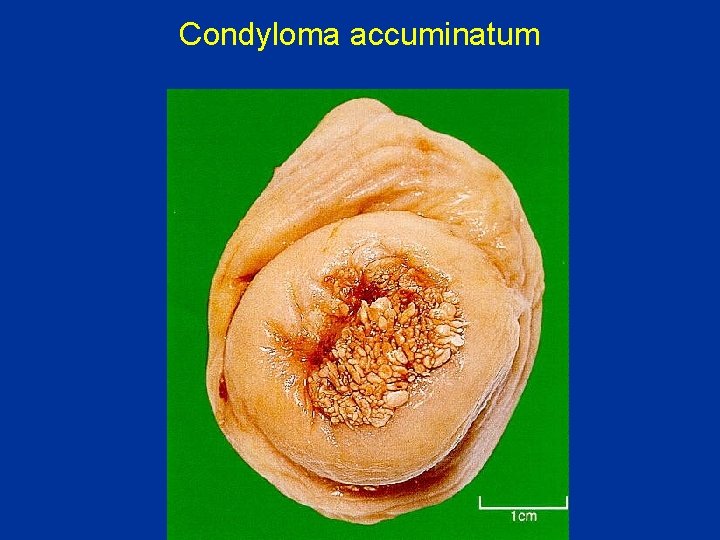 Condyloma accuminatum 