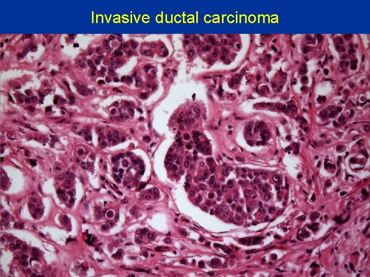 Invasive ductal carcinoma 