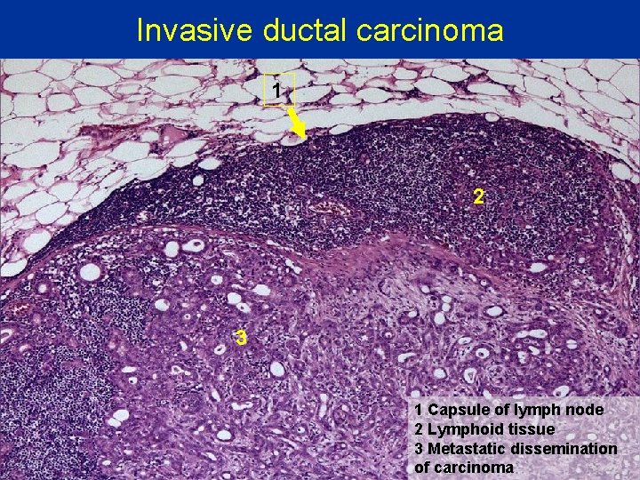 Invasive ductal carcinoma 1 2 3 1 Capsule of lymph node 2 Lymphoid tissue