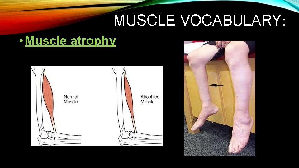 MUSCLE VOCABULARY: • Muscle atrophy MUSCLE VOCABULARY: • Muscle atrophy