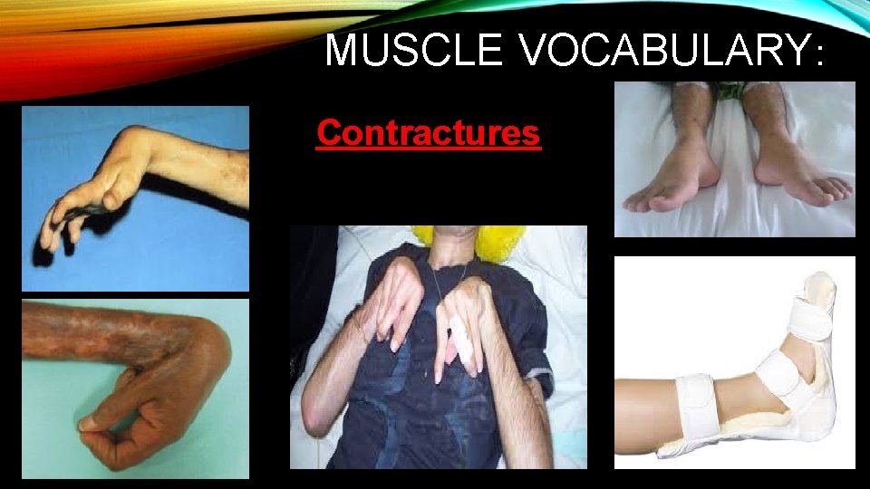 MUSCLE VOCABULARY: Contractures MUSCLE VOCABULARY: Contractures