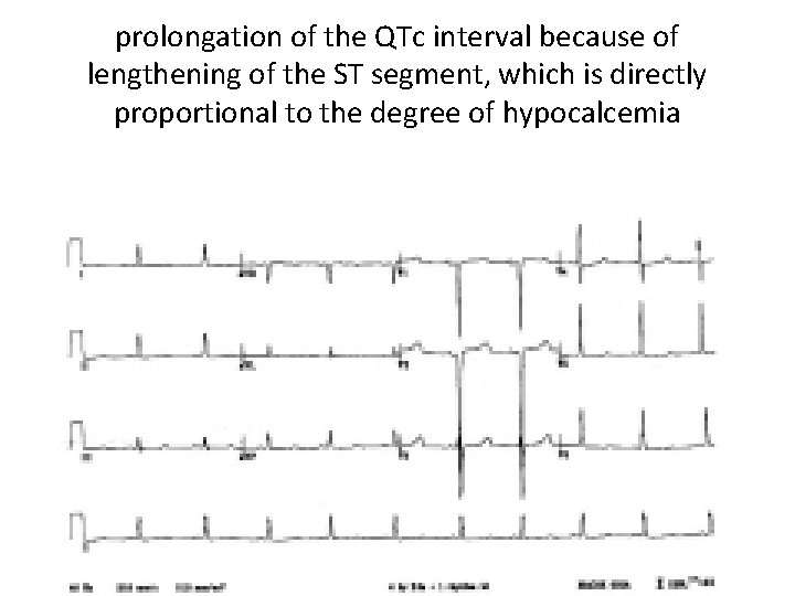 prolongation of the QTc interval because of lengthening of the ST segment, which is
