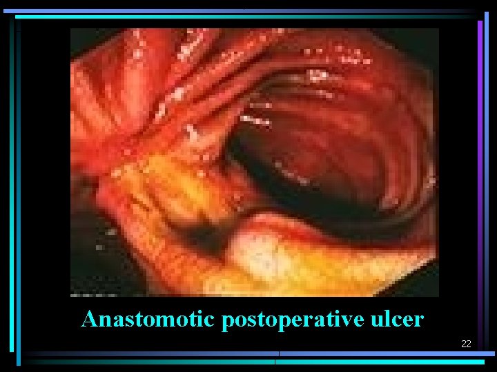 Anastomotic postoperative ulcer 22 