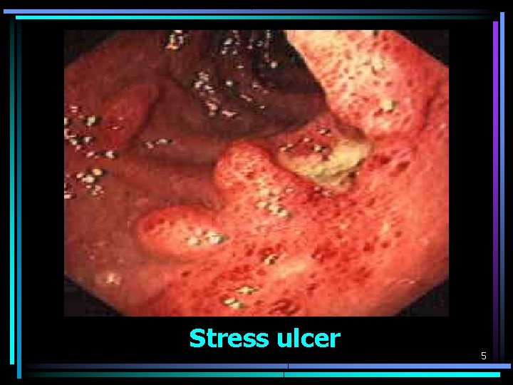 Stress ulcer 5 