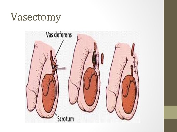 Vasectomy Vasectomy