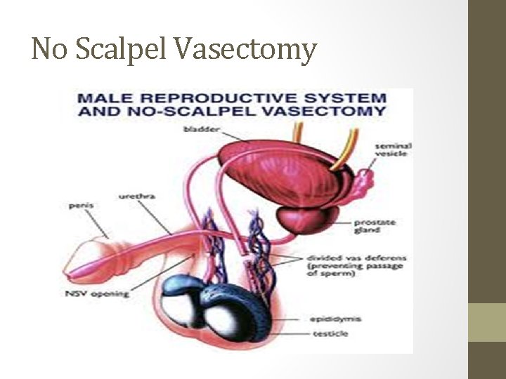 No Scalpel Vasectomy No Scalpel Vasectomy