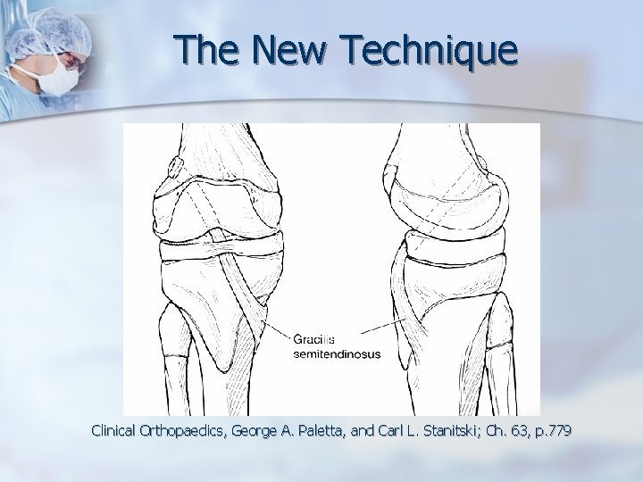 The New Technique Clinical Orthopaedics, George A. Paletta, and Carl L. Stanitski; Ch. 63,