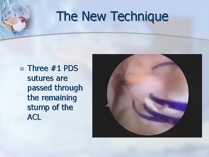 The New Technique n Three #1 PDS sutures are passed through the remaining stump