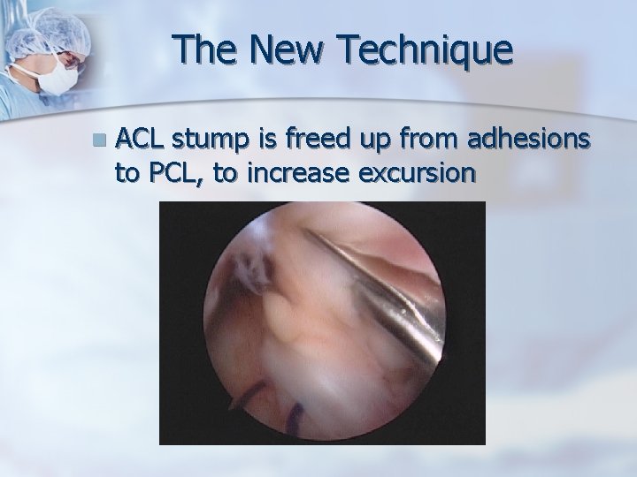 The New Technique n ACL stump is freed up from adhesions to PCL, to