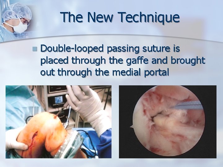 The New Technique n Double-looped passing suture is placed through the gaffe and brought