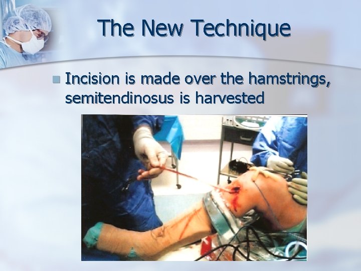 The New Technique n Incision is made over the hamstrings, semitendinosus is harvested 