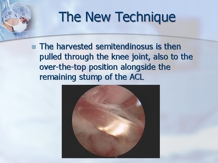 The New Technique n The harvested semitendinosus is then pulled through the knee joint,