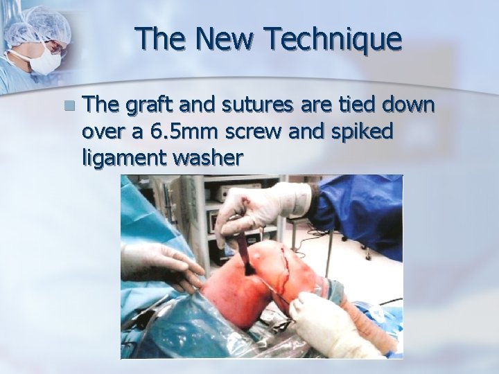 The New Technique n The graft and sutures are tied down over a 6.