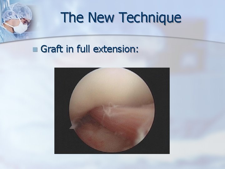 The New Technique n Graft in full extension: 