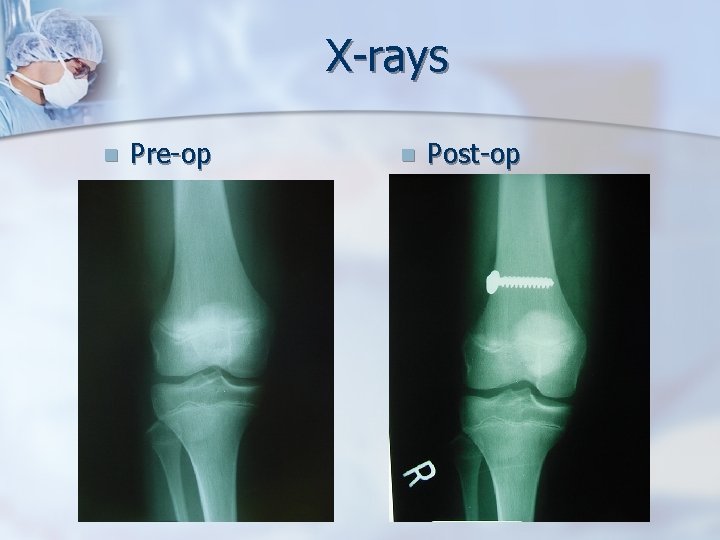 X-rays n Pre-op n Post-op 