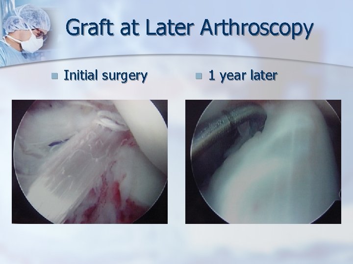 Graft at Later Arthroscopy n Initial surgery n 1 year later 