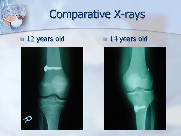 Comparative X-rays n 12 years old n 14 years old 