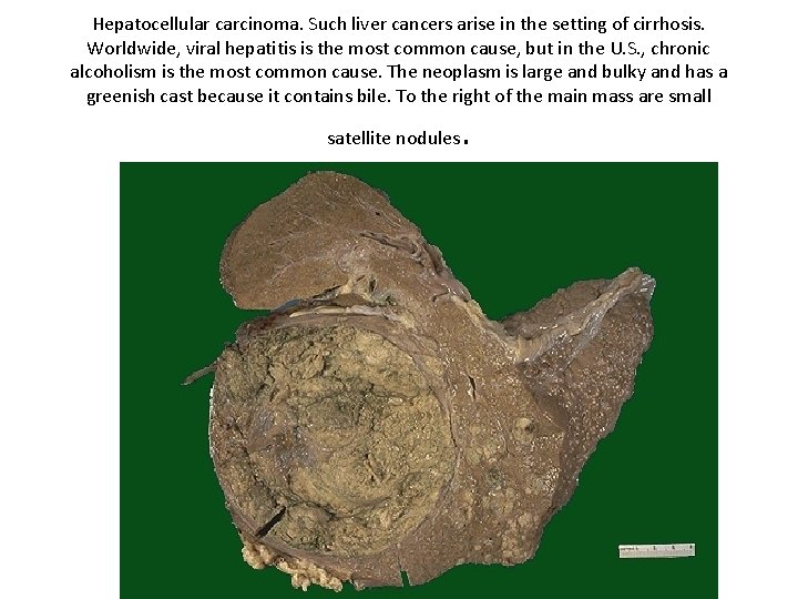 Hepatocellular carcinoma. Such liver cancers arise in the setting of cirrhosis. Worldwide, viral hepatitis