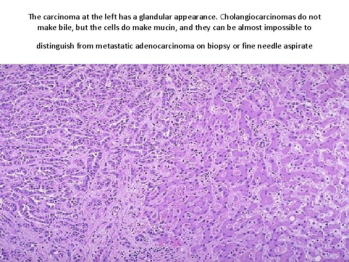 The carcinoma at the left has a glandular appearance. Cholangiocarcinomas do not make bile, The carcinoma at the left has a glandular appearance. Cholangiocarcinomas do not make bile,