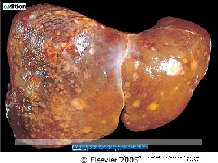 Downloaded from: Robbins & Cotran Pathologic Basis of Disease (on 9 March 2006 02: