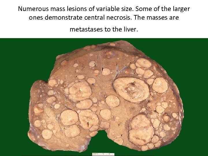 Numerous mass lesions of variable size. Some of the larger ones demonstrate central necrosis.