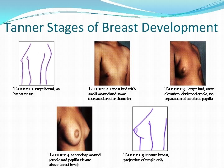 Tanner Stages of Breast Development Tanner 1 Prepubertal, no Tanner 2 Breast bud with Tanner Stages of Breast Development Tanner 1 Prepubertal, no Tanner 2 Breast bud with