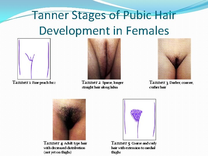 Tanner Stages of Pubic Hair Development in Females Tanner 1 Fine peach fuzz Tanner Tanner Stages of Pubic Hair Development in Females Tanner 1 Fine peach fuzz Tanner