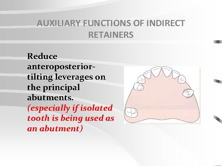 AUXILIARY FUNCTIONS OF INDIRECT RETAINERS Reduce anteroposteriortilting leverages on the principal abutments. (especially if