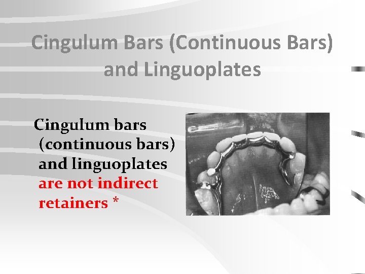 Cingulum Bars (Continuous Bars) and Linguoplates Cingulum bars (continuous bars) and linguoplates are not