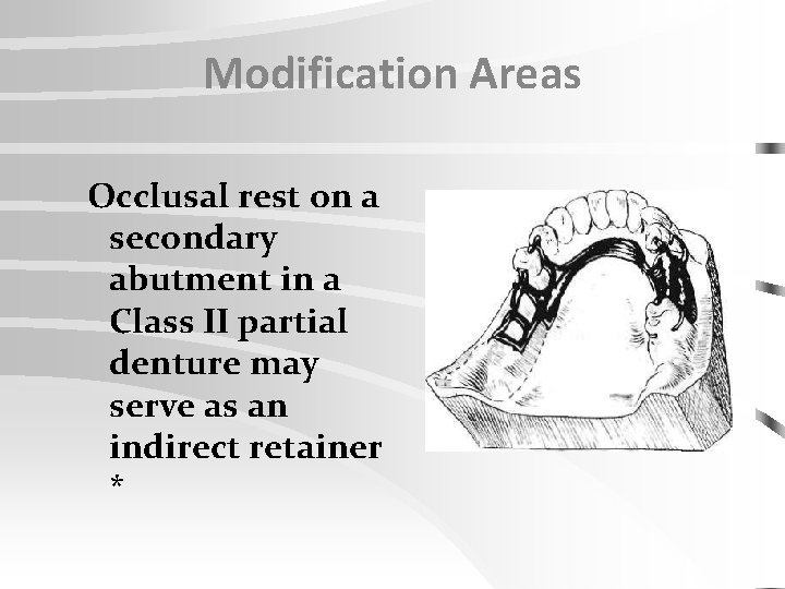 Modification Areas Occlusal rest on a secondary abutment in a Class II partial denture