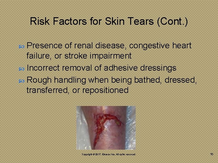 Risk Factors for Skin Tears (Cont. ) Presence of renal disease, congestive heart failure,