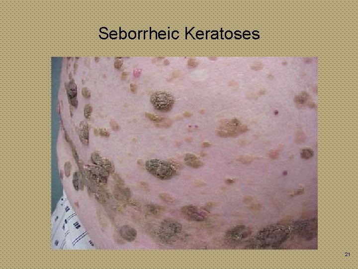 Seborrheic Keratoses 21 