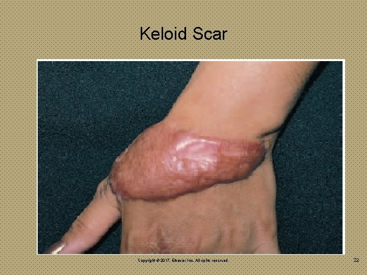 Keloid Scar Copyright © 2017, Elsevier Inc. All rights reserved. 22 