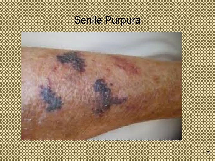 Senile Purpura 23 