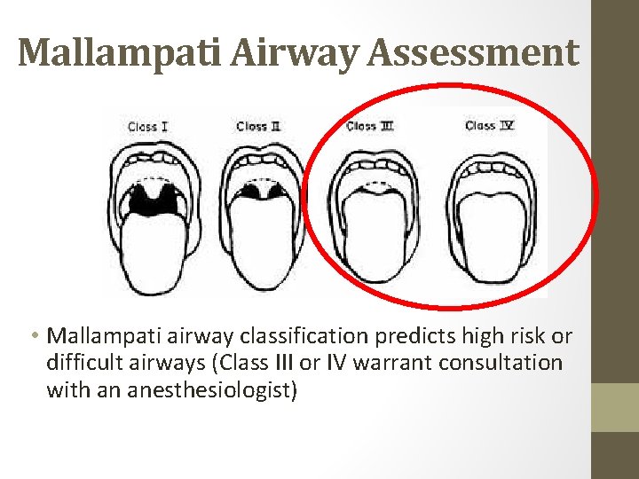 Mallampati Airway Assessment • Mallampati airway classification predicts high risk or difficult airways (Class