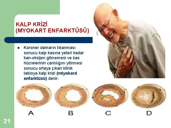 KALP KRİZİ (MYOKART ENFARKTÜSÜ) l 21 Koroner damarın tıkanması sonucu kalp kasına yeteri kadar