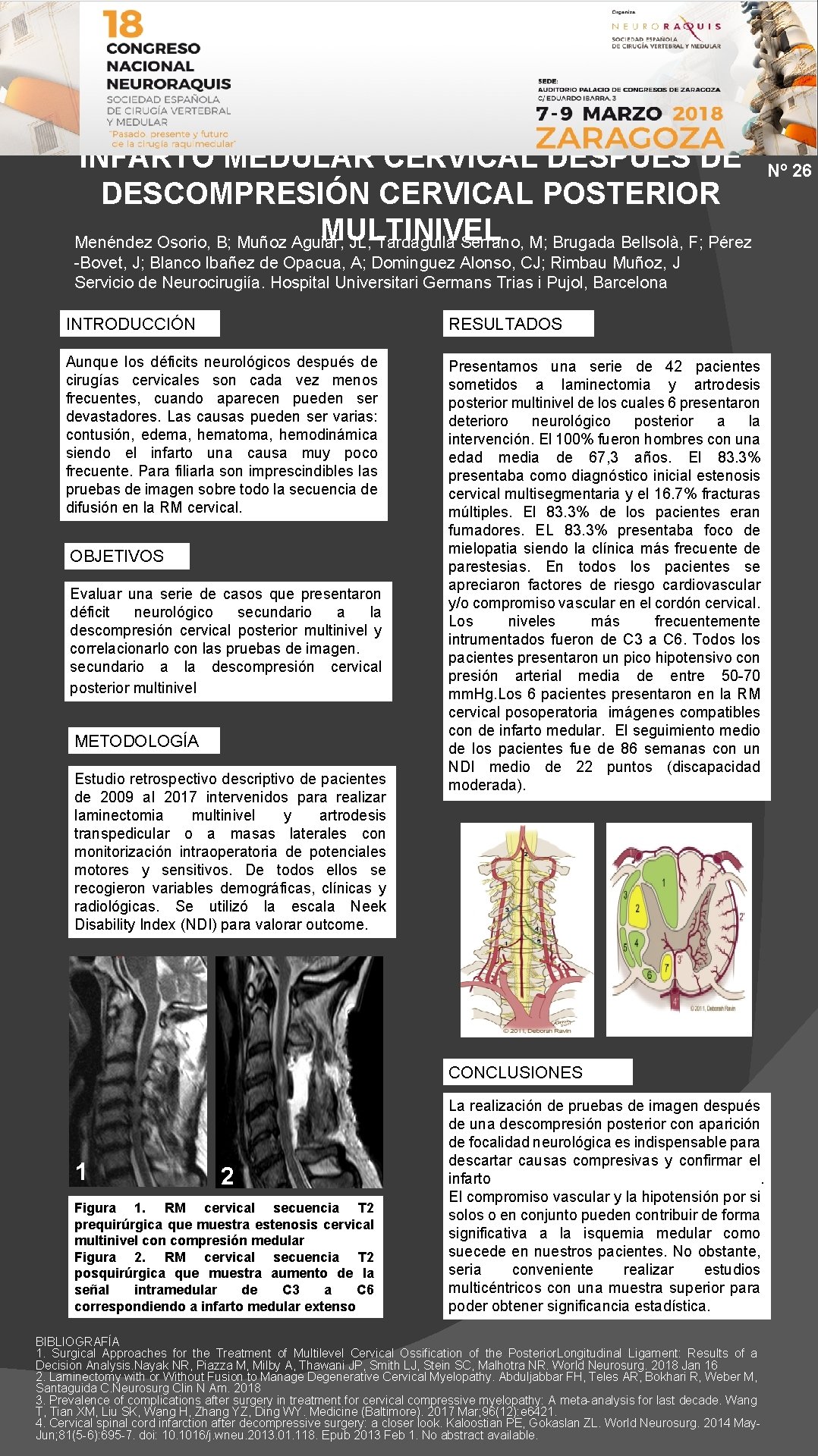 INFARTO MEDULAR CERVICAL DESPUÉS DE DESCOMPRESIÓN CERVICAL POSTERIOR MULTINIVEL Menéndez Osorio, B; Muñoz Aguiar,