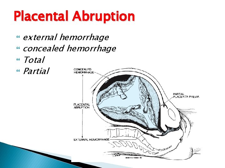 Placental Abruption external hemorrhage concealed hemorrhage Total Partial 
