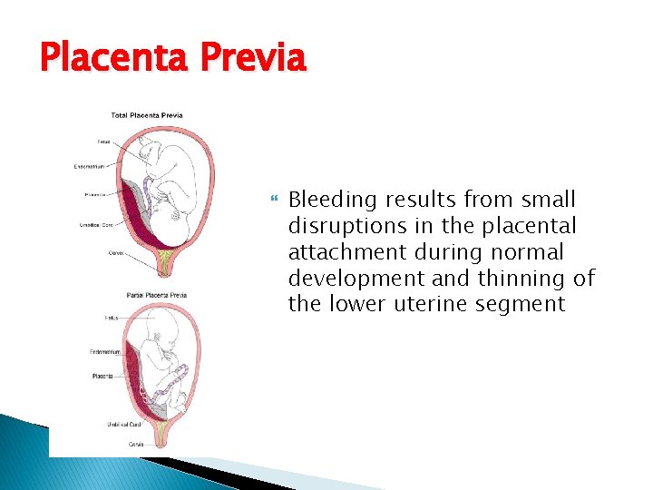 Placenta Previa Bleeding results from small disruptions in the placental attachment during normal development