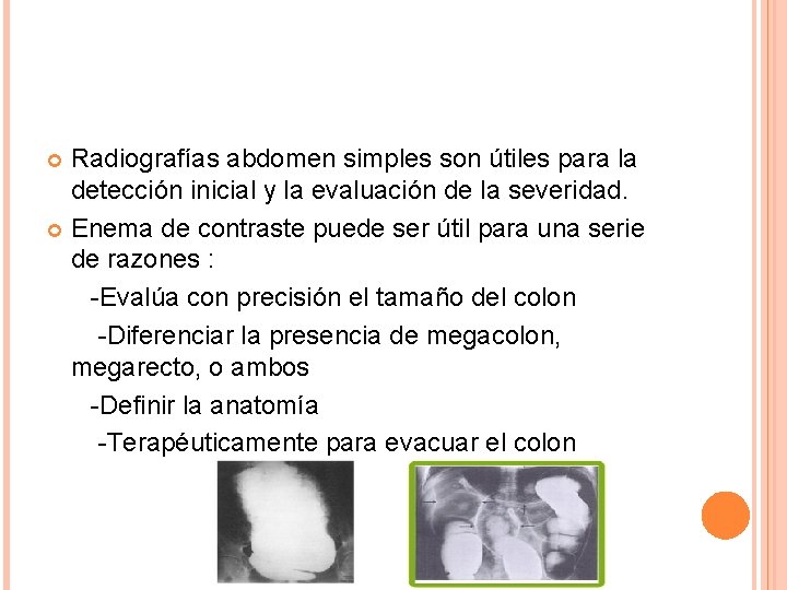 Radiografías abdomen simples son útiles para la detección inicial y la evaluación de la