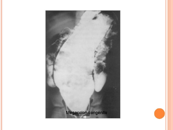 Megacolon congénito 