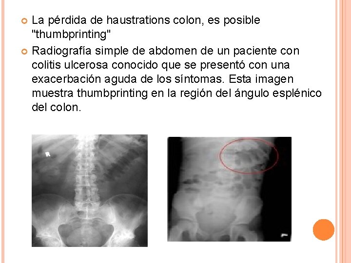 La pérdida de haustrations colon, es posible "thumbprinting" Radiografía simple de abdomen de un