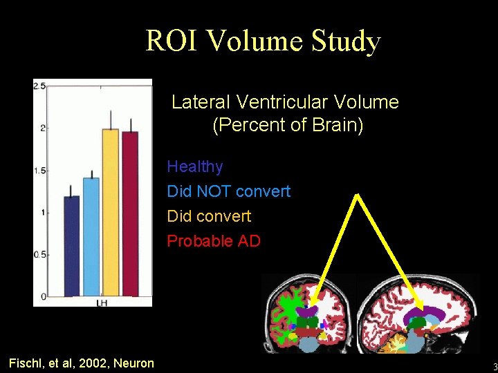 ROI Volume Study Lateral Ventricular Volume (Percent of Brain) Healthy Did NOT convert Did