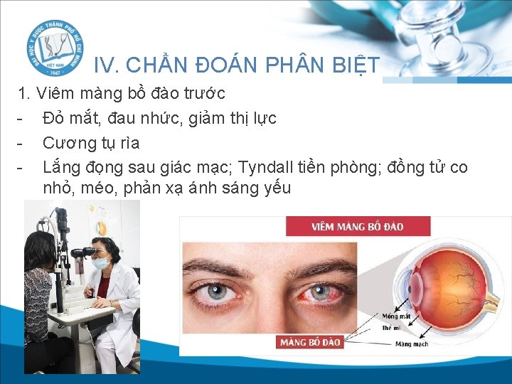 IV. CHẨN ĐOÁN PH N BIỆT 1. Viêm màng bồ đào trước - Đỏ