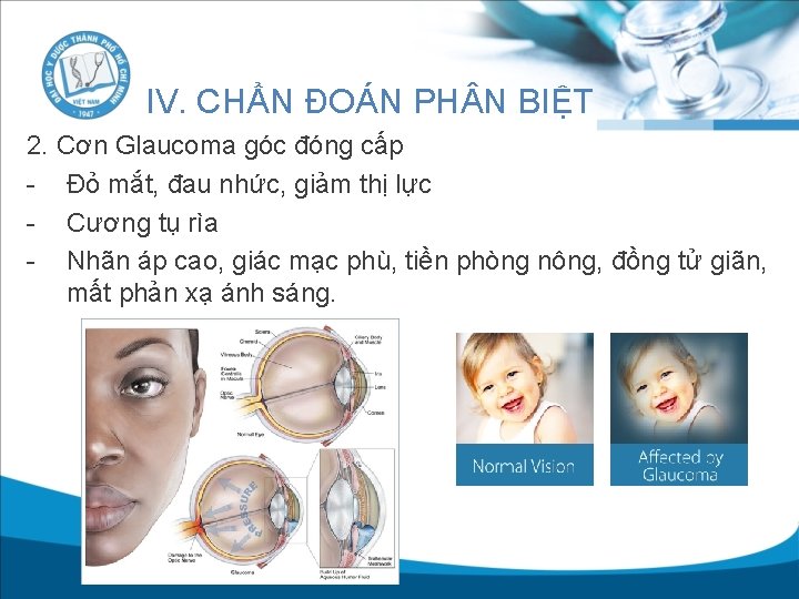 IV. CHẨN ĐOÁN PH N BIỆT 2. Cơn Glaucoma góc đóng cấp - Đỏ