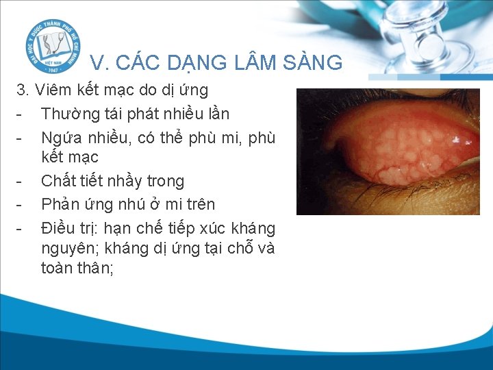 V. CÁC DẠNG L M SÀNG 3. Viêm kết mạc do dị ứng -